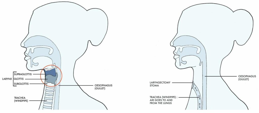 medspeechinc-Laryngectomy and Alaryngeal Speech