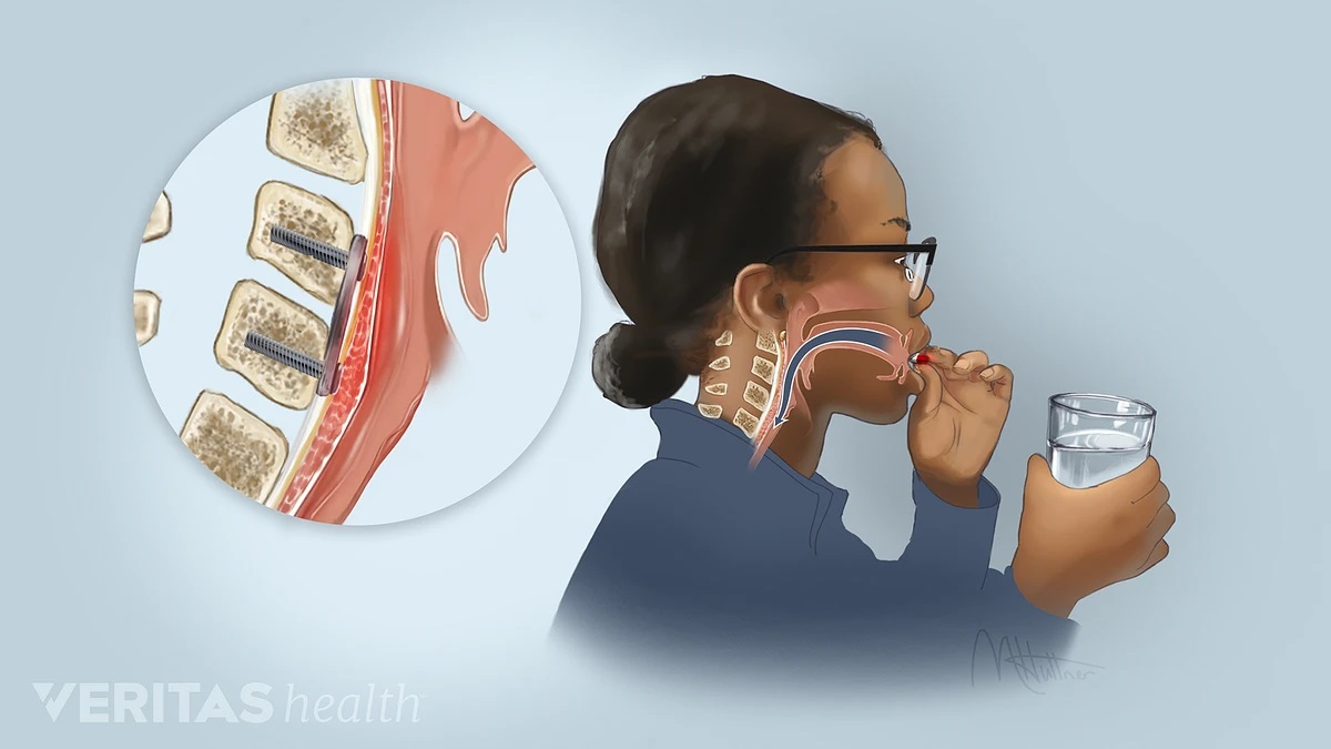 Dysphagia Following Cervical Fusion Medspeech Inc 0704